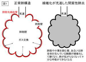 美空ひばり,病名