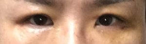 眼瞼下垂手術後,体験談,腫れ,ダウンタイム
