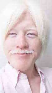 アルビノ,日本人,モデル